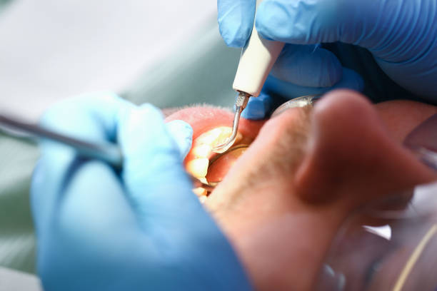 Best Emergency Dental Care for Broken or Chipped Teeth in La Grange, IL